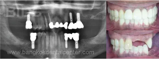 Multiple Implants