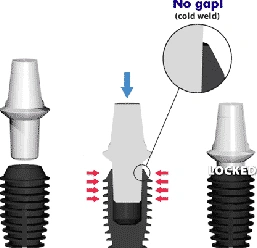 Bicon Implant