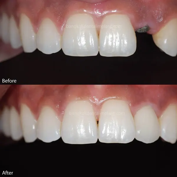 Dental Implant