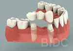 Dental Bridge