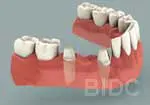 Dental Bridge
