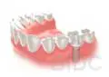 Dental Impant step 5