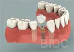 Dental Implant
