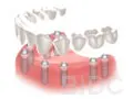 implant bridge step