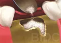Implant Overdenture
