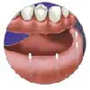 Intra Lock Minature Implants