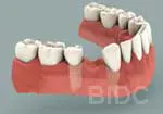Missing Tooth