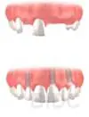 multiple missing upper