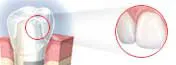 Nobel Biocare Crown