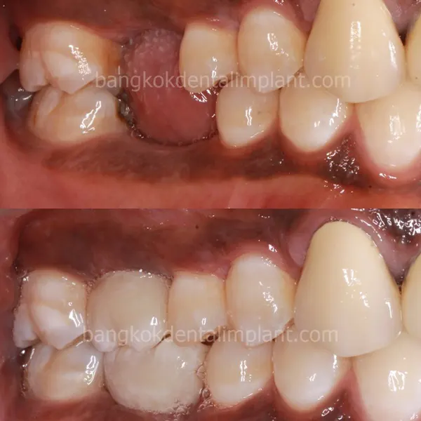 Single Implant