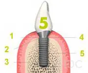 Straumann Bone