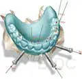 teeth in an hour