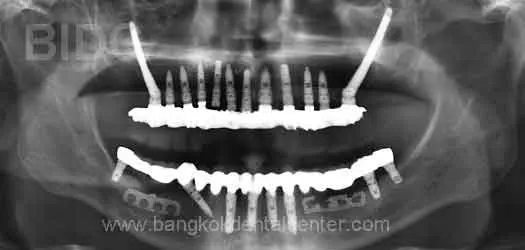 zygoma ferwada