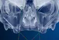 zygoma implant