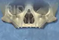 zygoma implant