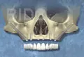 zygoma implant step